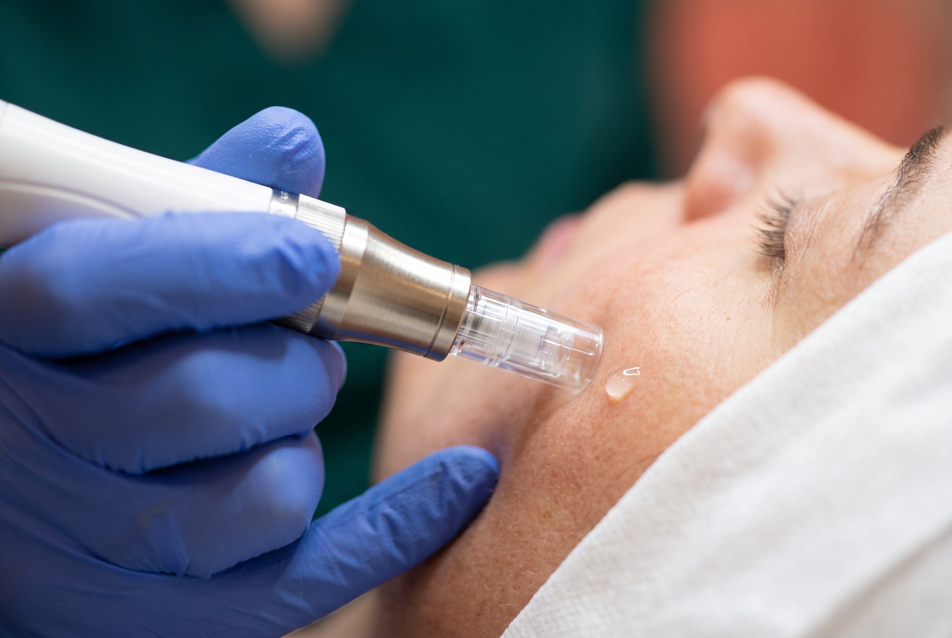 Microneedling treatment being performed on a patient's cheek